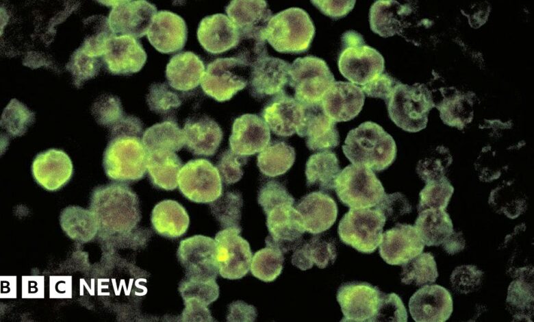 Florida resident dies from brain-eating amoeba